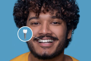 Dental Implants showing on the camera shown by the by the boy smiling facing front camera