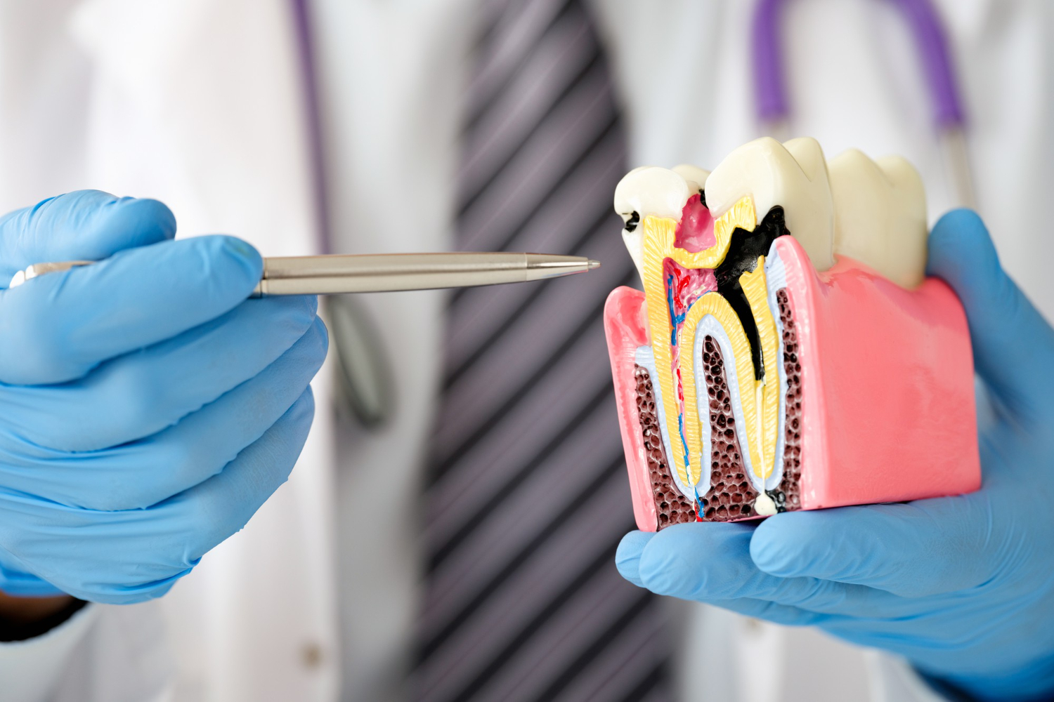 Dental bone regeneration and bone grafting illustration for dental implant treatment in Reading, PA