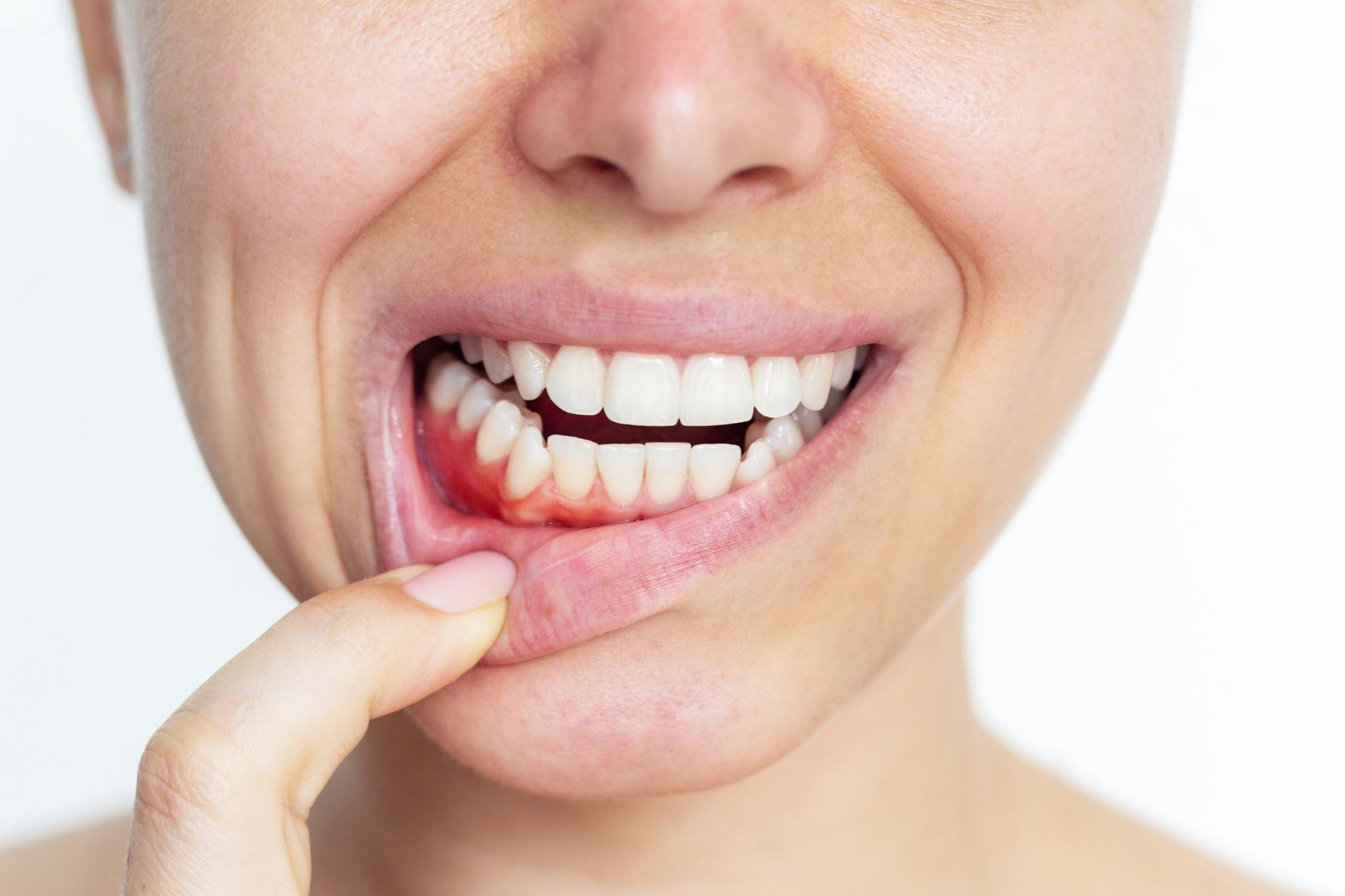 Woman showing inflamed gums and a red, swollen area around the lower teeth, suggesting gum disease.
