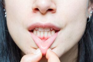 Close-up of a woman showing her teeth and pulling down her lower lip to reveal red, irritated gums.