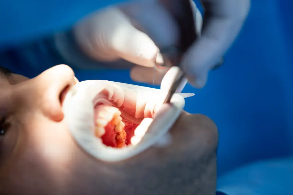 Dentist performing bone grafting while examining a patient’s gums and teeth during a dental bone graft healing procedure.